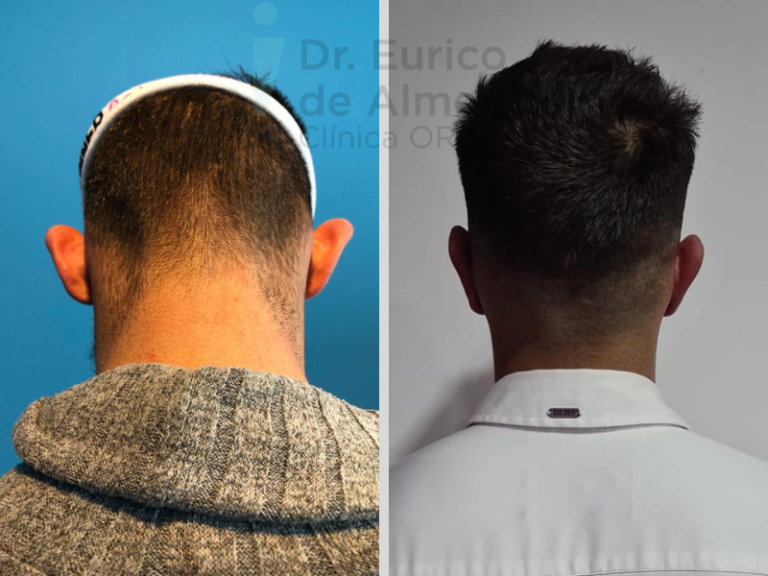 otoplastia masculina antes e depois