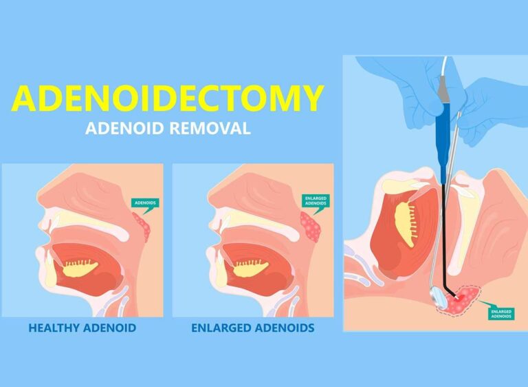 Cirurgia às Adenóides e Amígdalas Infantil - Clínica ORL