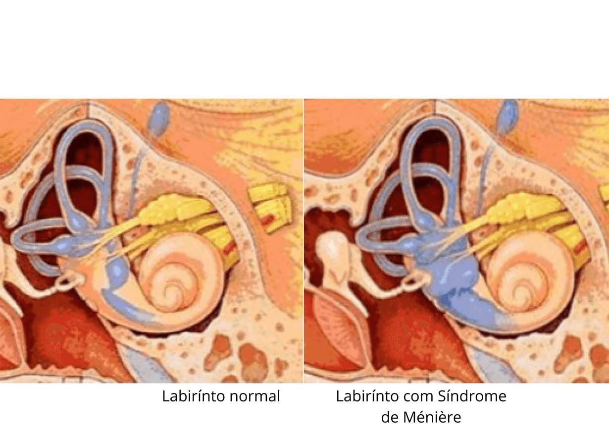 labirinto do ouvido com e sem síndrome de ménière