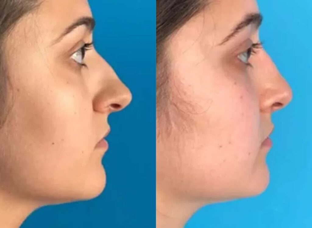 cirurgia plástica nariz antes e depois