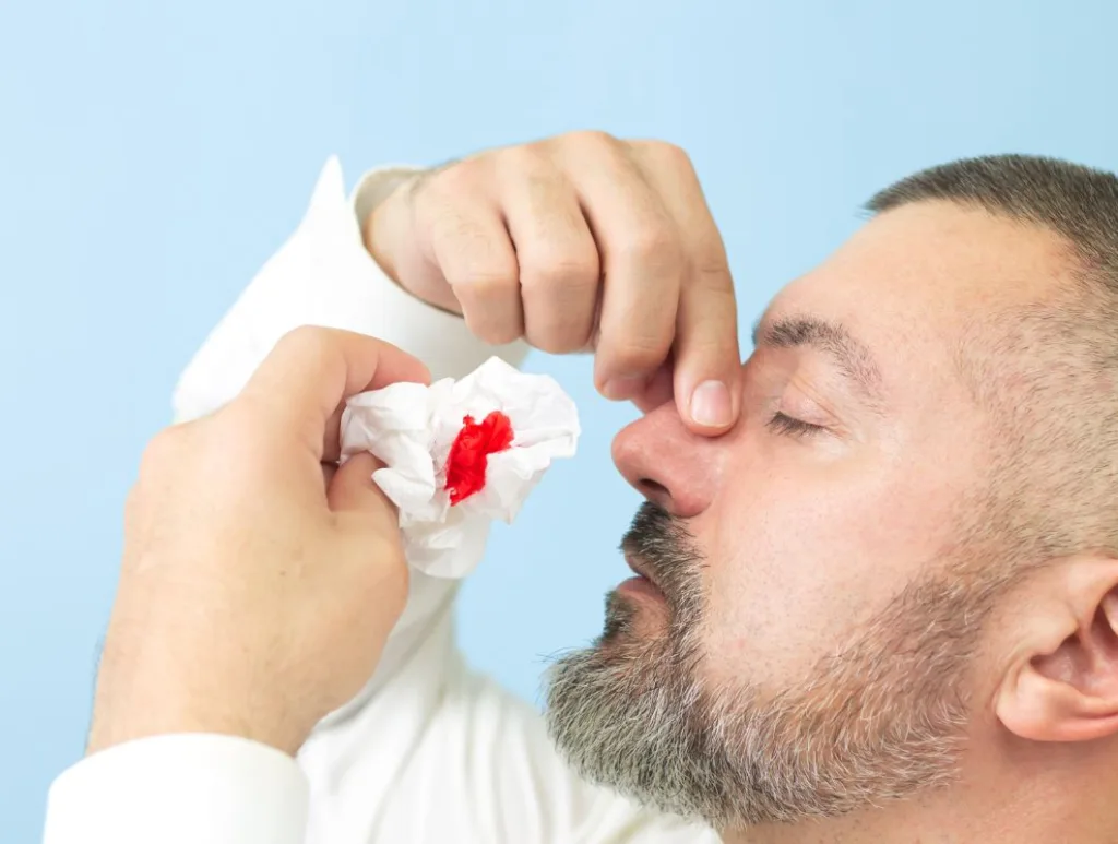 espistaxis