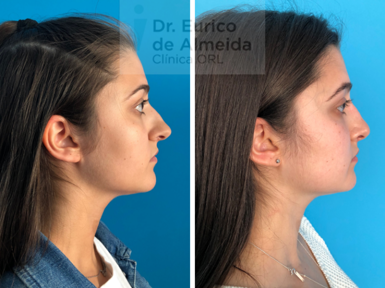 cirurgia plástica nariz porto antes e depois
