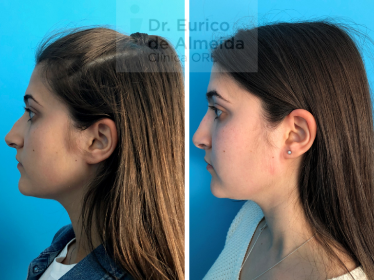 cirurgia nariz porto antes e depois
