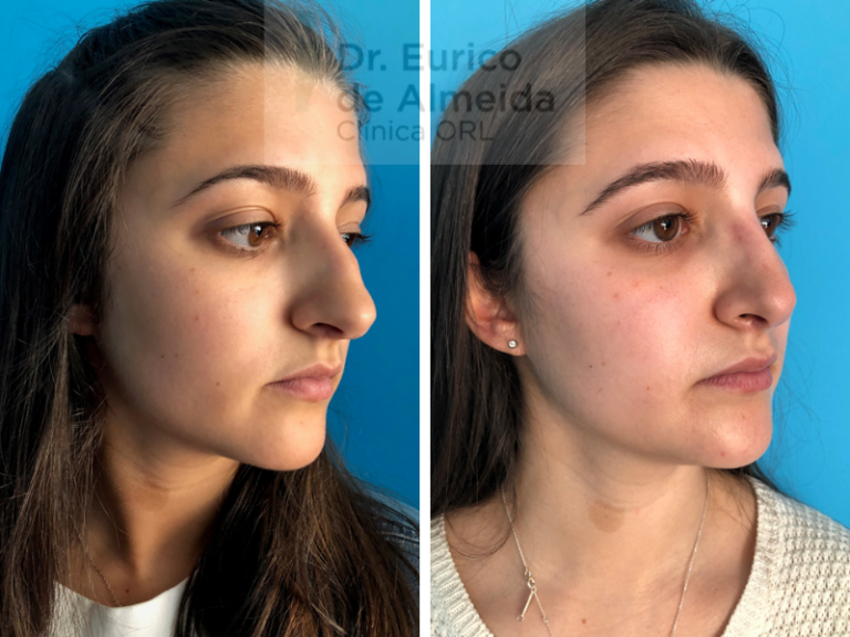 cirurgia nariz antes e depois