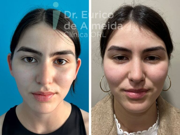 cirurgia orelhas antes e depois