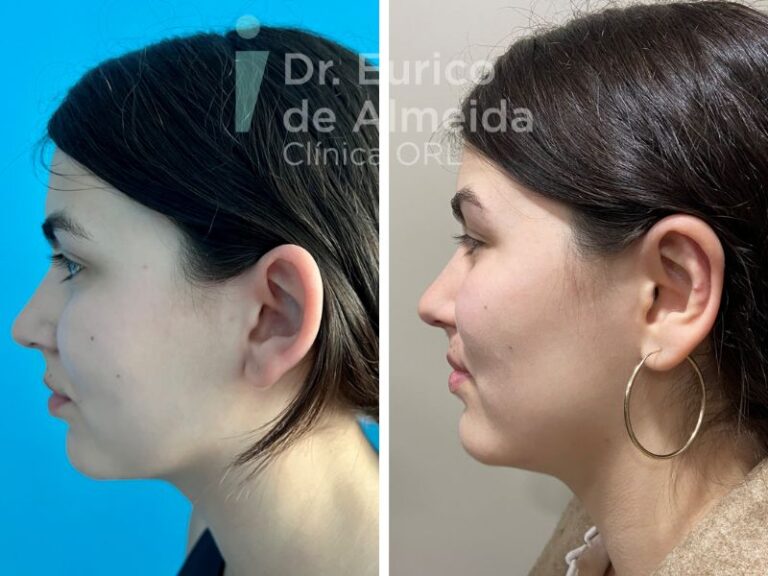 cirurgia orelhas perspetiva lateral antes e depois