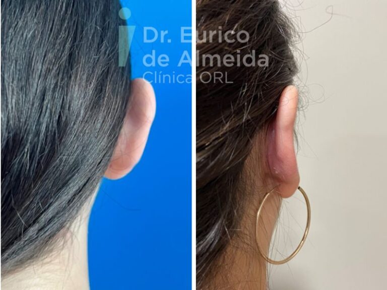 cirurgia orelhas antes e depois (visão traseira)