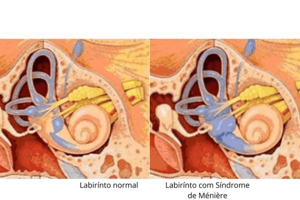 labirinto do ouvido com e sem síndrome de ménière