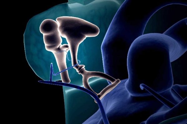 otosclerose-o-que-e-e-como-deve-ser-tratada otosclerose-o-que-e-e-como-deve-ser-tratada