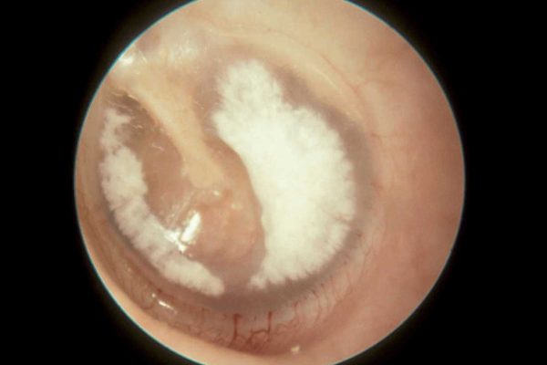 timpanosclerose-o-que-e-e-como-tratar timpanosclerose-o-que-e-e-como-tratar